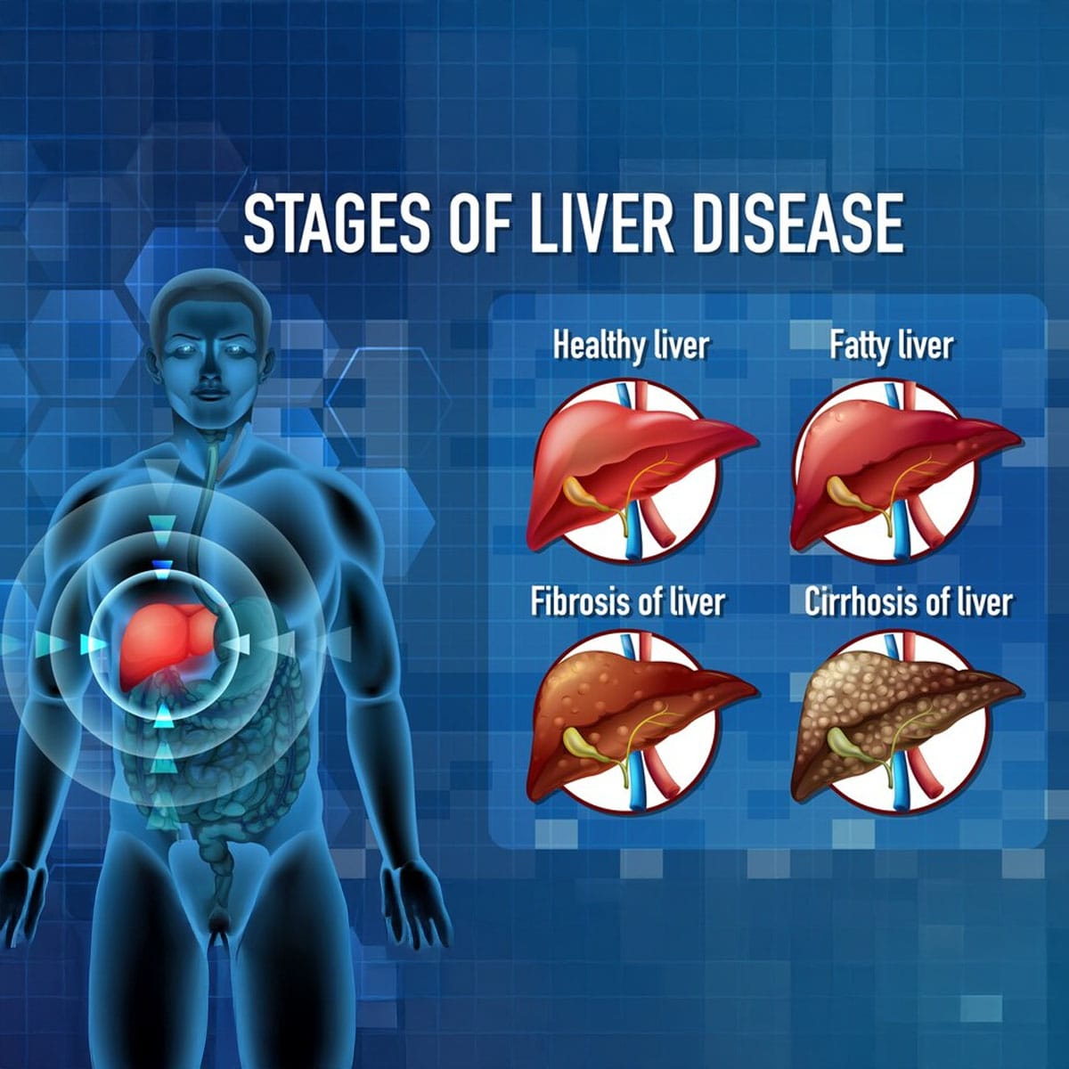 NAFLD/NASH research, NASH innovation, fibrosis reversal, liver-brain axis, non-invasive diagnostics