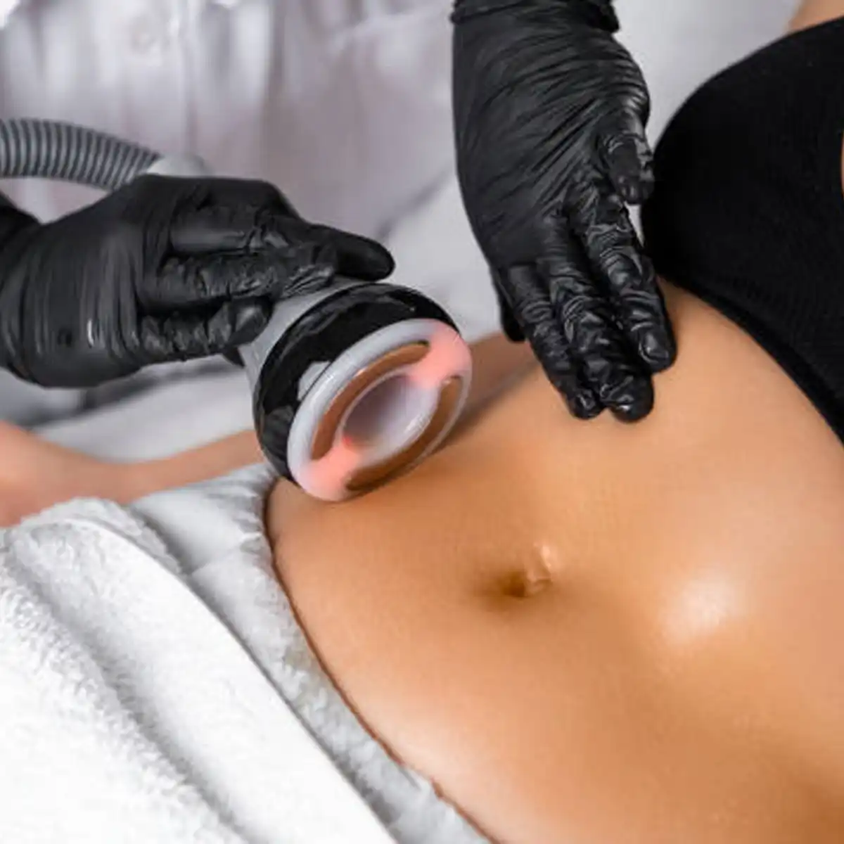 Calciphylaxis